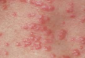Throughout this article, we have provided images of how different rash might cause the skin to appear. Std Pictures Herpes Genital Warts Gonorrhea Std Symptoms Testing