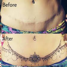We've got scar tattoos of all shapes and sizes that can. Tummy Tuck Scar Coverup Tattoo By Empire Empire Tattoo Studio Sri Lanka Facebook