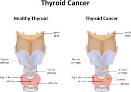 A physical exam will give more information about signs of thyroid cancer and other health problems. Detecting And Treating Thyroid Cancer Cardiac Screen