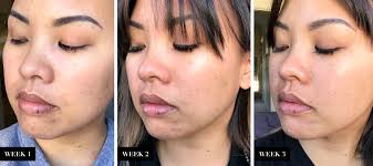 The Skincare System That Calmed Down My Acne