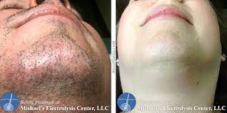 Electrolysis is a form of hair removal to treat unwanted or excessive hair growth. Before After Electrolysis Hair Removal Mishael S Electrolysis Center