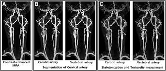 Hemifacial Spasm Caused By Tortuous Vertebrobasilar Artery: A Case Report |  The Egyptian Journal Of Neurology, Psychiatry And Neurosurgery | Full Text