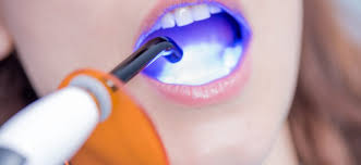 How much tooth bonding cost. Dental Bonding Cost Of Adhesive Direct Composite Bonding