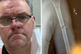 Fundraiser by Regie Hamm : Regie's busted arm fund