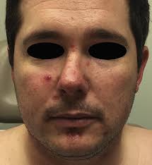 Coxsackievirus B5 associated with hand-foot-mouth disease in a healthy adult