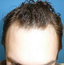 At la fue hair clinic we provide a natural looking and the best fue hair transplant and fue hair restoration services to clients who suffer from hair loss using the latest technique follicular unit extraction fue. Hair Care Products For Hair Loss Meshkin Medical 949 219 0027 Hair Transplant And Restoration Newport Beach