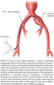 We did not find results for: Advanced Aneurysm Management Techniques Management Of Internal Iliac Aneurysm Disease Thoracic Key