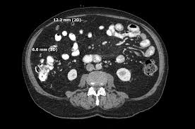 A neoplastic origin is considered by many authors to require a surgical excision, based on the high recurrence and progressive growth rate of the tumors. Cureus Benign Multicystic Peritoneal Mesothelioma Presenting As A Colonic Mass