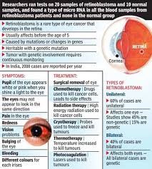 In a photo, instead of red eye, a child with retinoblastoma will. Blood Test To Help Detect Eye Cancer In Children India News Times Of India