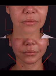 New Story of Facial Rejuvenation Check the 5 days results of our beautiful  46 year-old patient after full facial rejuvenation: