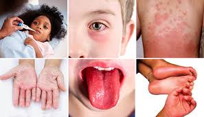 The rash is likely a delayed allergic reaction or hypersensitivity. The New Way Covid 19 Might Be Affecting Kids Children S Wisconsin