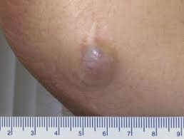 Also called neuroendocrine carcinoma of the skin or trabecular cancer, merkel cell carcinoma is a very rare type of skin cancer that forms when. Merkel Cell Carcinoma Dermnet Nz