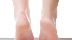 Pieds Gonfles Par La Chaleur 4 Remedes Pour Vite Degonfler Soin Des Pieds Peau Morte Pied Bain De Pied Bicarbonate