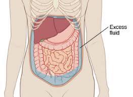 Fluid build up after tummy tuck what is cause? Discharge Instructions For Paracentesis