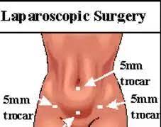 No running after insurance authorities. Hysterectomy Surgeons Surgical Specialist Denver Co