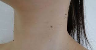 一度できるとなかなかしつこいイボ その多くがウイルス性の良性のものと言われれ 皮膚科での治療が行われます しかし時には治療をしてもなかなか取れないイボ もあります 今回は そんなしつこいイボをレモンを使って綺麗に取ることができたある女性の体験談とその方法