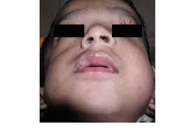 Facial asymmetry observed due to the swelling