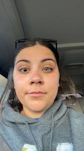 Severe reaction to scopolamine patch