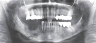 Image result for dental cancer