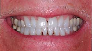 Consult with your orthodontist to see if this option is right for your specific case. What Causes Dark Triangles Between Teeth Impressions Orthodontics