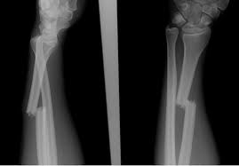 Image result for Galeazzi Sign