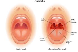 Image result for Tonsillitis