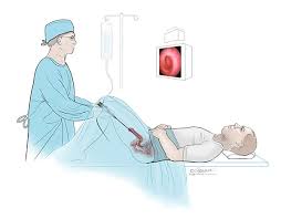 Voiding cystourethrography (vcug), also known as a micturating cystourethrography (mcu), is a fluoroscopic study of the lower urinary tract in which contrast is introduced into the bladder via a. Benign Not Cancerous Uretheral Lesions Boys Symptoms Diagnosis Treatment Urology Care Foundation