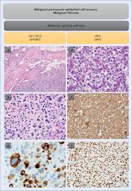 A benign tumor is not considered cancer. Malignant Tumors Of The Pecoma Family A As Per Definition Malignant Download Scientific Diagram