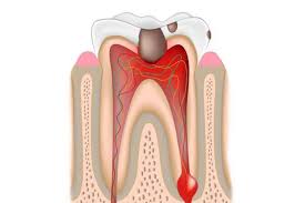 Periodontitis treatment includes deep cleaning or periodontitis surgery. Periodontitis What Is It How And Why Does It Manifest Symptoms Treatment Prices