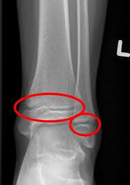 Image result for Ankle XRay