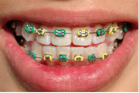 Sometimes, wearing dental braces can be a part of growing up. Diy Braces Amazing Smiles Orthodontics Forest Hills Orthodontics