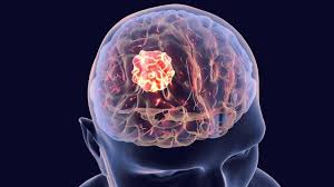 Learn what cancer is and what causes it. Brain Tumor Severity And Survival May Be Dependent On Sex Earth Com