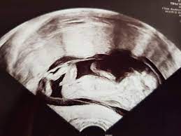 Es ist nicht obligatorisch, dass sie das geschlecht des babys während der. Sieht Man Hier Schon Das Geschlecht Baby Ultraschall