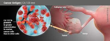 Tumor markers are used to help detect, diagnose, and manage some types of cancer. Ca 125 Ovarian Tumor Marker Blood Test Results