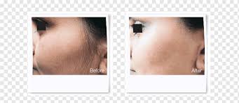 With the exception of the eyelashes, it is safe for all areas of the face, including your sideburns and upper lip. Laser Hair Removal Korperhaarentfernung Laser Treatment Face Lip Hair Png Pngwing