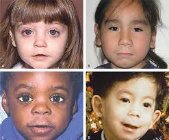 The nsdc can also help with federal grants and loans for special districts. What Is Fetal Alcohol Spectrum Disorder Fasd Vitalite