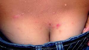 Image result for scabies symptoms