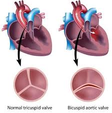 Spesso alterazioni piuttosto gravi del cuore possono deorrere in totale assenza di soffi ed adirittura esistono casi in cui la scomparsa di un soffio precedentemente auscultabile è indicativa di un peggioramento di una cardiopatia del bambino piuttosto che di un miglioramento! Che Cosa E Una Valvola Aortica Bicuspide