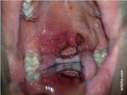 Strep throat is caused by streptococcus bacteria and causes fever and persistent pain. Peritonsillar Abscess Quinsy Entsho Com
