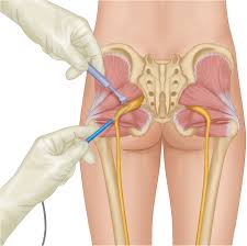 A Minimally Invasive Surgical Approach For The Treatment Of Piriformis Syndrome A Case Series Chinese Neurosurgical Journal Full Text