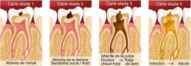 Le traitement orthodontique des dents mal alignées ou des malocclusions, comme elles sont appelées professionnellement, est souvent retardé jusqu'à ce que toutes les dents permanentes aient fait leur éruption, vers l'âge de 12 ans. Comment Soulager Et Soigner Vite Et Bien Une Rage De Dents