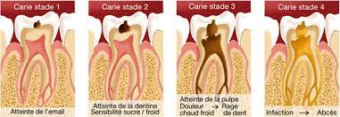 Vous souffrez d'une douleur dentaire lorsque vous vous avez un mal de dents persistant et l'une de vos joues est enflée, et si c'était un abcès dentaire ? Comment Soulager Et Soigner Vite Et Bien Une Rage De Dents