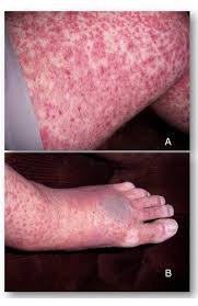 Many of the causes of petechiae can result in a petechial rash on the front or side of the legs or ankles. The Clinical Implications Of Adult Onset Henoch Schonelin Purpura Clinical And Molecular Allergy Full Text