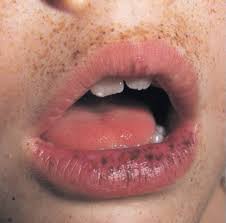 This spots can appear on various parts of the body that include cheeks, forehead, on the chin, upper lip, and lower lip. Pin On Syndromes