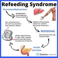 Image result for Refeeding Syndrome