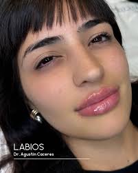 ✨ El tratamiento de labios busca realzar tu forma natural, manteniendo  armonía y proporción con el rostro. Trabajo con ácido hialurónico para  mejorar el contorno, la hidratación y la proyección, sin perder