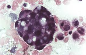 Most often, however, the pleural fluid cytology . Effusion Sediment Cluster Of Malignant Mesothelial Cells With Typical Download Scientific Diagram
