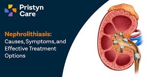 Image result for Calcium Nephrolithiasis