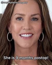 Bethany, 52, is 7 days after her Omakase Facelift®️She has a disarming,  gentle sweetness about her. Her surgery included:✓ Deep plane extended  facelift✓ Deep necklift (#neckbynayak)✓ Minimal incision browlift ✓ Upper  blepharoplasty