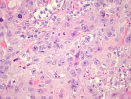 What causes a squamous cell carcinoma? Squamous Cell Carcinoma Pathology Dermnet Nz